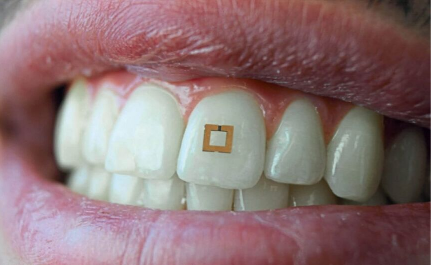 Diş Yüzeyine Yerleştirilen Sensörler ile Diyet Takibi 